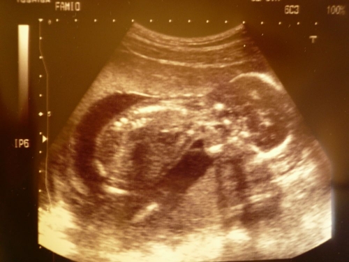 obrázek Ultrazvuk v 17. týdnu a 6 dní